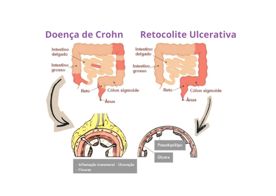 Ilustração comparando doença de Crohn e retocolite ulcerativa. 
