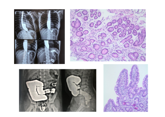 Montagem com imagens de exames de Gastropediatria, sendo elas imagens contrastadas do trado digestivo (radiografia esôfago-estômago-duodeno e enema opaco) e imagens de biópsias do trato digestivo,  uma delas mostra as vilosidades do duodeno