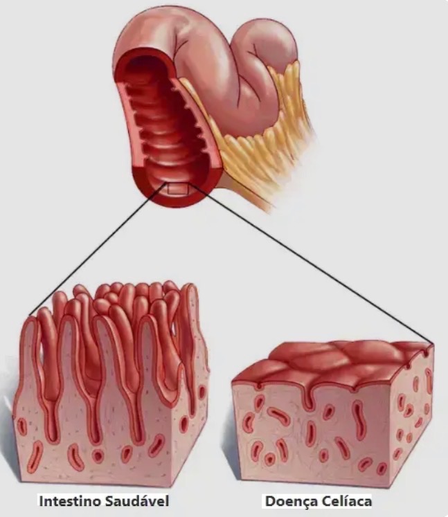 Ilustração comparando mucosa de duodeno normal vs mucosa de duodeno na doença celíaca atrofiada